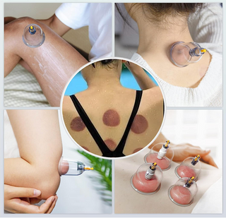 32 Piece Cupping Therapy Kit